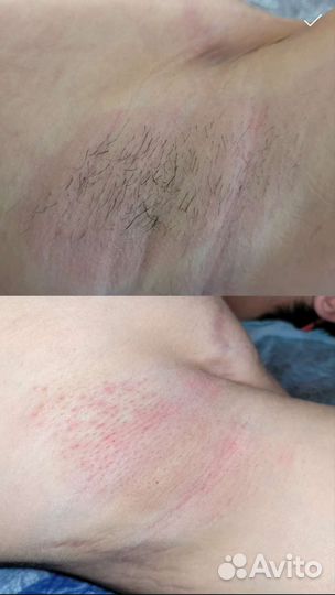 Электроэпиляция: подмышки