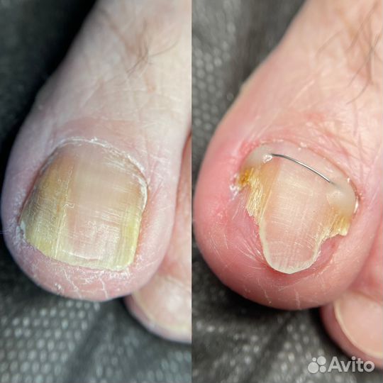 Подолог. Вросший ноготь. Титановая нить