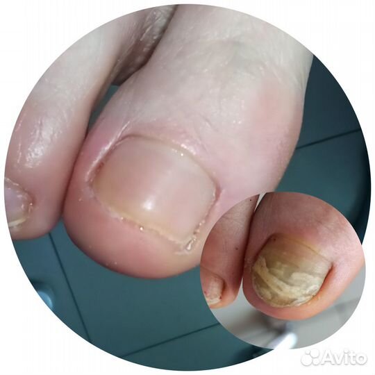 Медицинский педикюр,маникюр.Услуги подолога