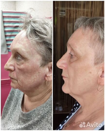 Микроигольчатый РФ лифтинг