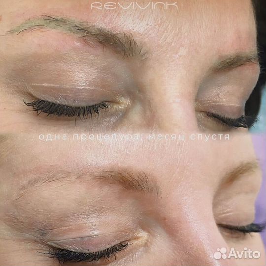 Лазерное удаление тату