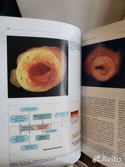 Ишемическая болезнь сердца