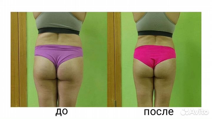 LPG массаж, кавитация, rf