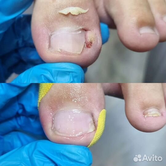 Аппаратный педикюр