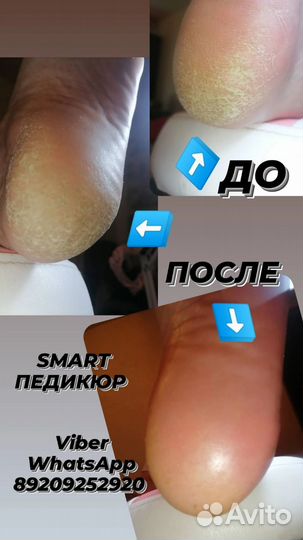 Педикюр на дому