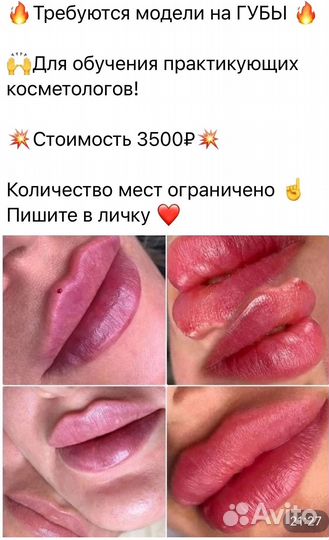 Модели на ботокс(100/ед),липолитики,губы