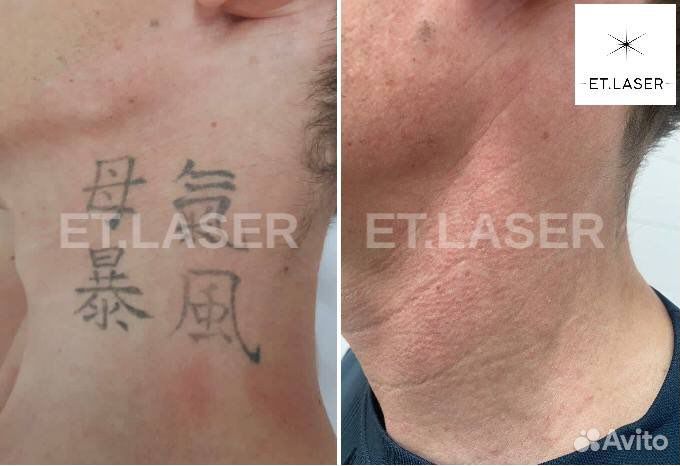 Удаление тату