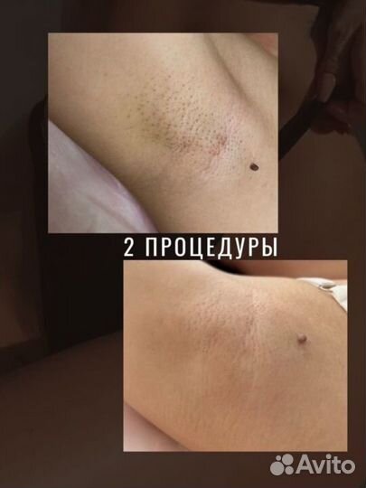 Лазерная эпиляция