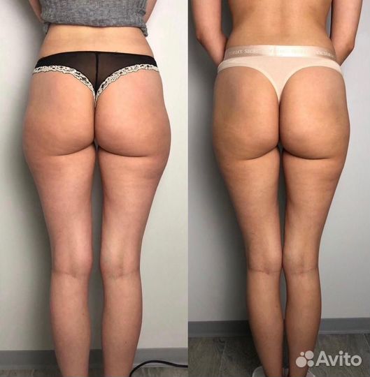 Ручная липосакция