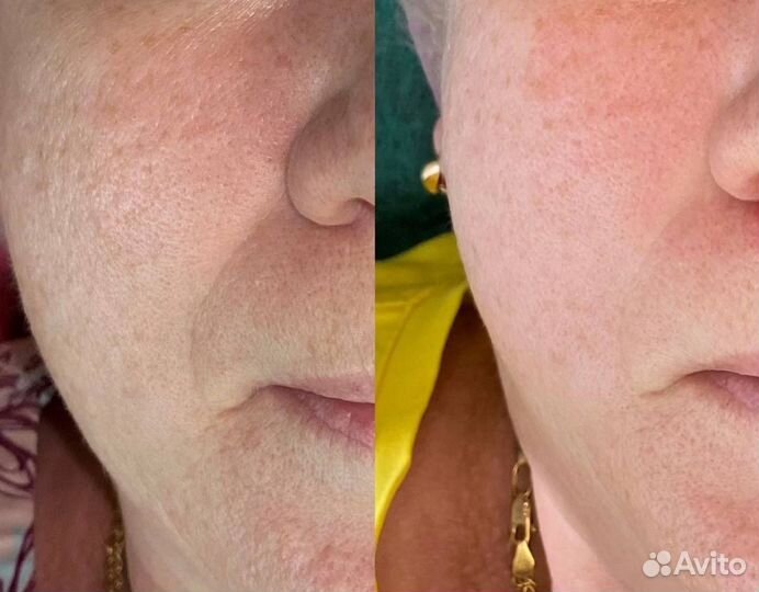 Омоложение лица FlaxSculpt