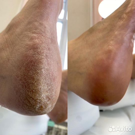 Смарт педикюр