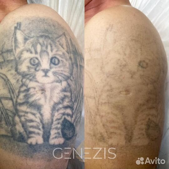 Удаление/осветление тату и татуажа лазером