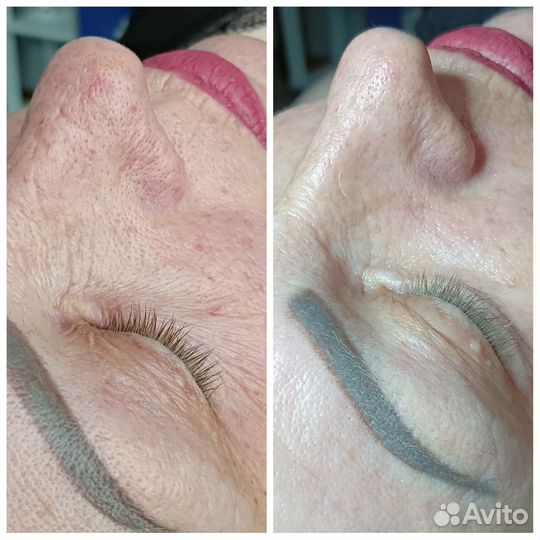 Чистка лица, эстетическая косметология