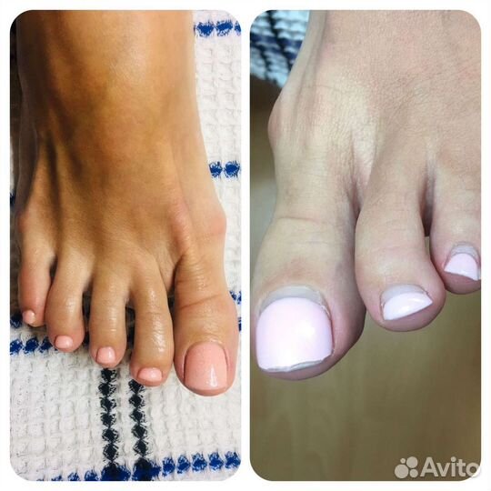 Аппаратный педикюр на дому