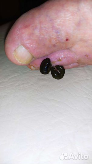 Купон на гирудотерапию