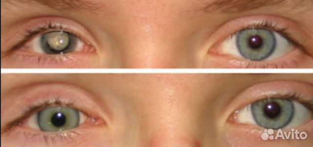 Линза, скрывающая дефект глаз