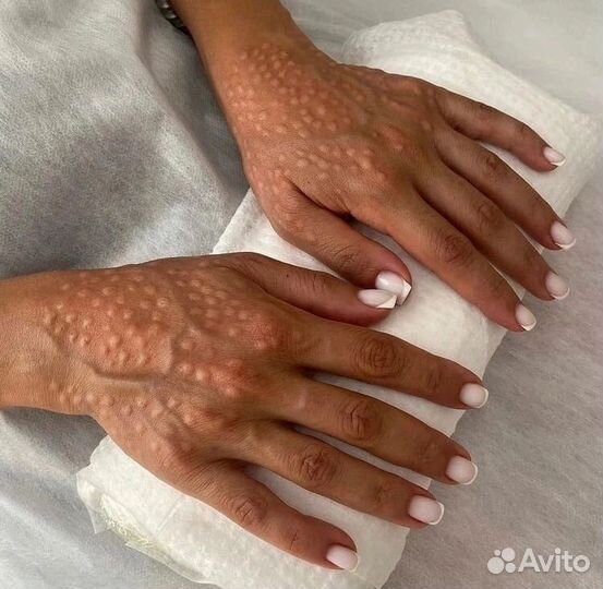 Омолаживание лица