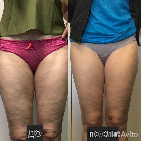 Массаж коррекция фигуры похудение