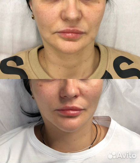 Подтяжка лица, брыли, мезонити, золотые нити