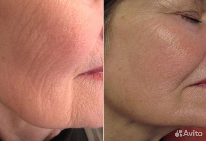 Игольчатый РФ лифтинг РФ лифтинг