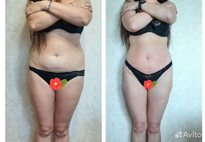 Массаж лица и тела. Lpg массаж. Коррекция фигуры