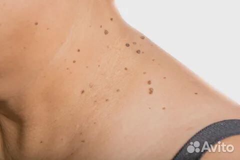 Удаление папилом, родинок, шипиц