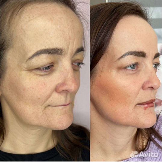 Косметолог/чистка лица/увеличение губ/ботокс/нити