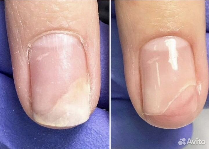 Подология Педикюр Маникюр Вросшие ногти Мазоли
