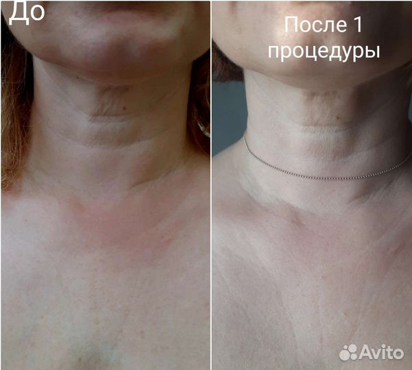 Холодная плазма