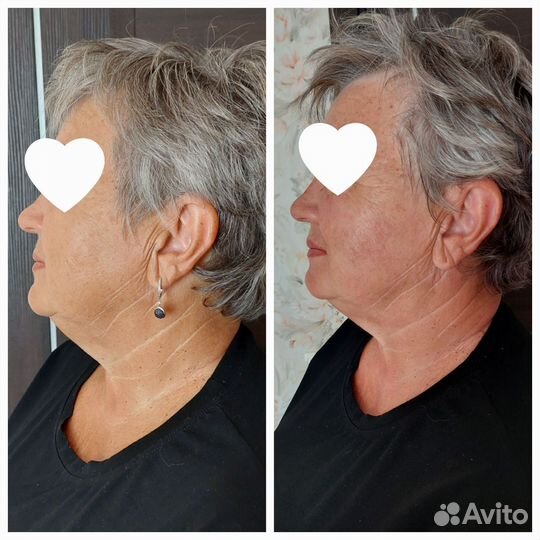 Смас лифтинг тела