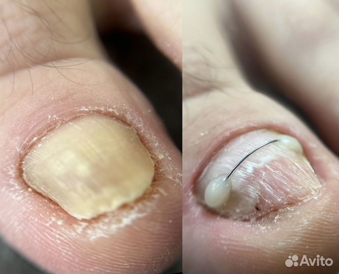 Медицинский педикюр