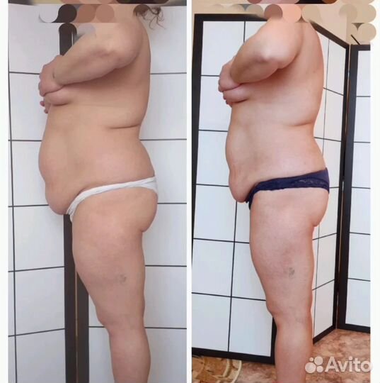 Вакуумно-роликовый массаж тела LPG