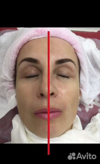 Скульптурный массаж лица