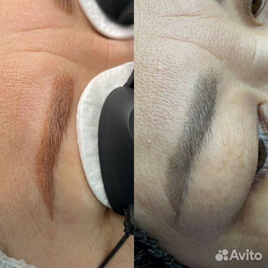 Удаление татуажа