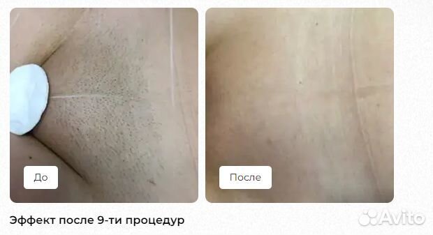 Лазерная эпиляция в Питере