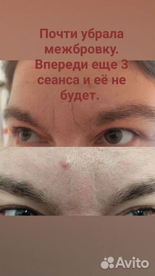 Ручная пластика лица