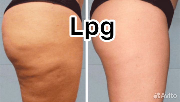 LPG массаж тела и лица