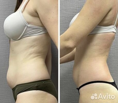 Аппарат для коррекции фигуры Resolady