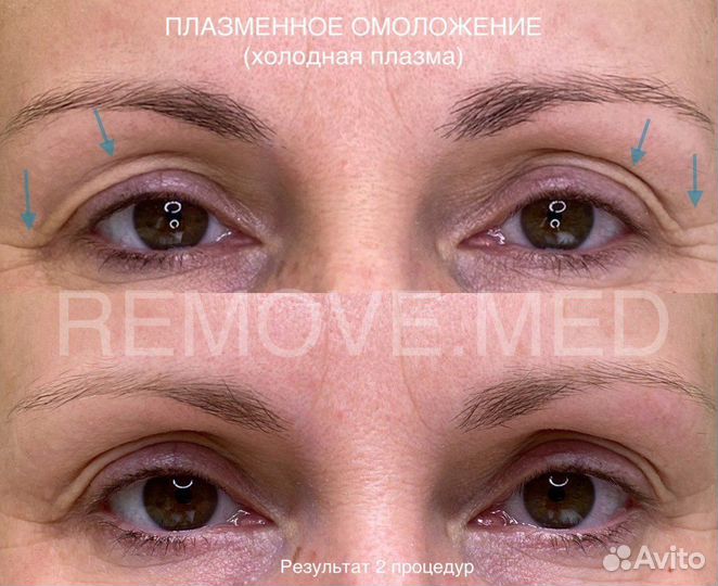 Холодная плазма процедуры обучение