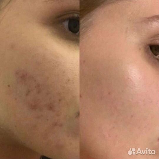 Косметолог чистка лица