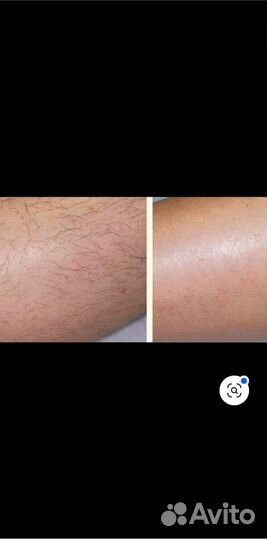 Лазерная эпиляция