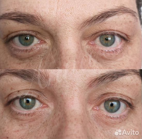 Холодная плазма, подтяжка лица, шеи и век