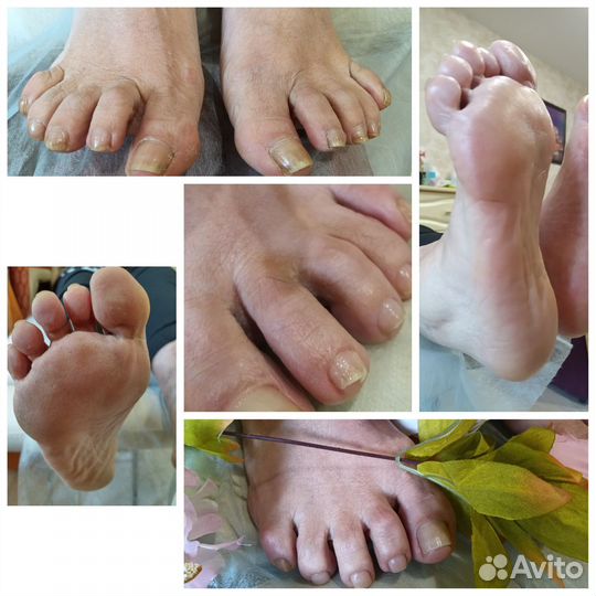 Педикюр на дому