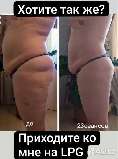 Вакуумно-роликовый массаж тела LPG