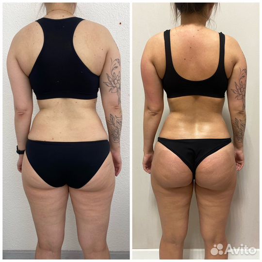 Коррекция фигуры/вакуумный массаж