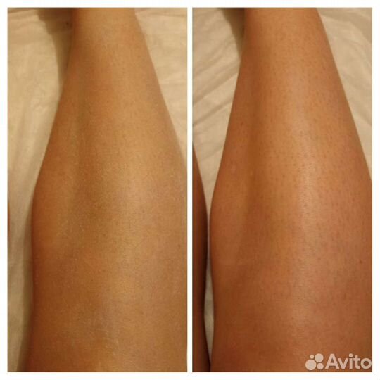 Шугаринг в солнечном