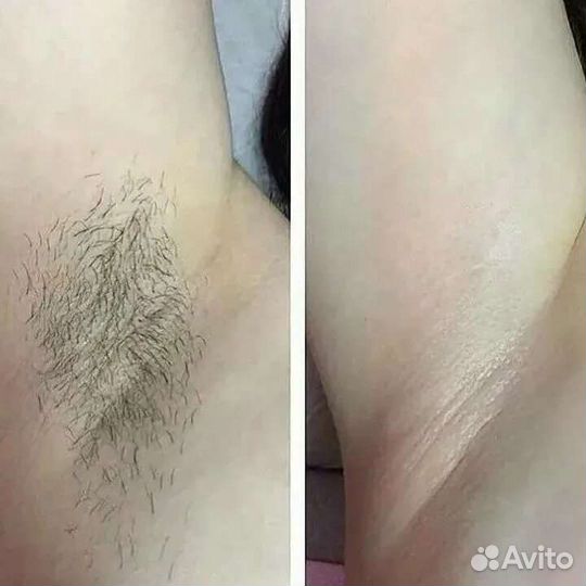 Депиляция, шугаринг