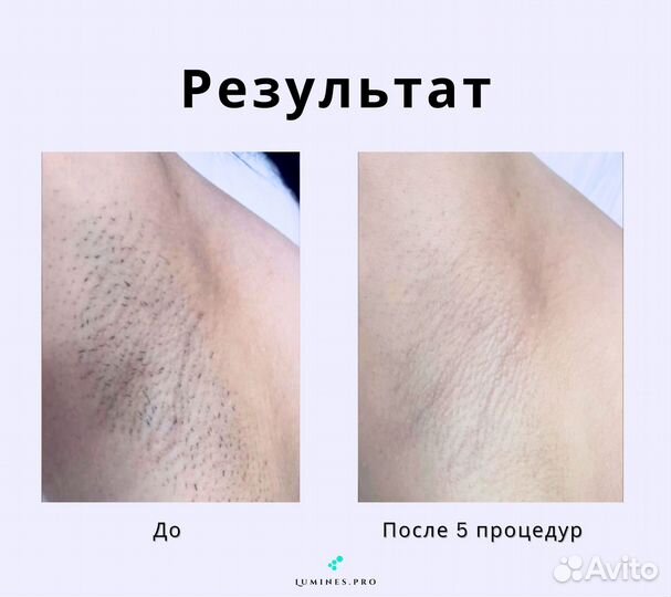 Диодный лазер для эпиляции Lumines Макс’Ван 1200в