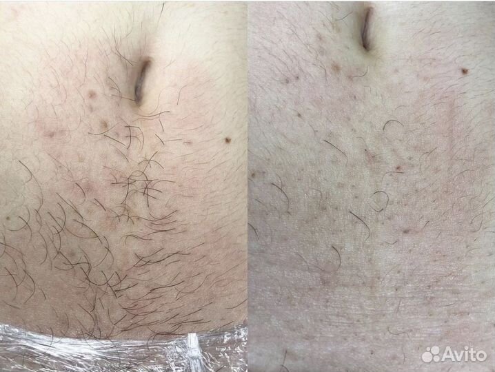 Электроэпиляция удаление волос навсегда