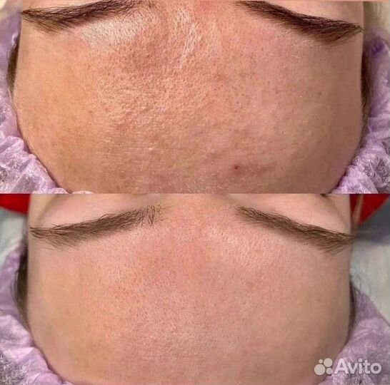 Косметолог чистка лица уз + механическая + пилинг